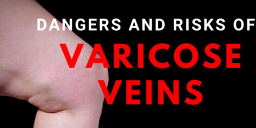 5 Hidden Dangers of Varicose Veins