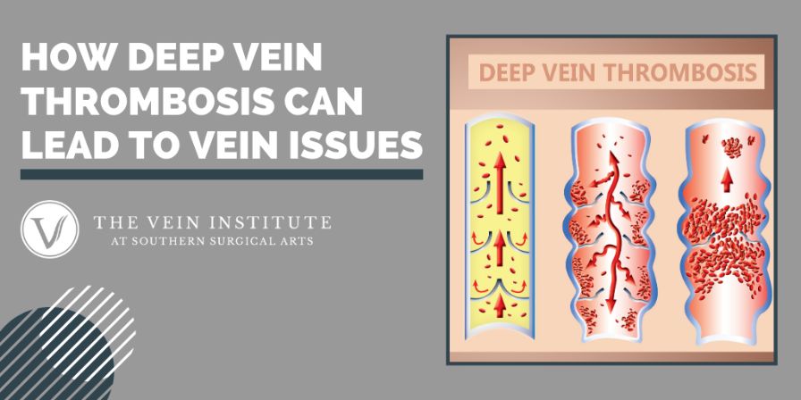 How Deep Vein Thrombosis Can Lead to Vein Issues