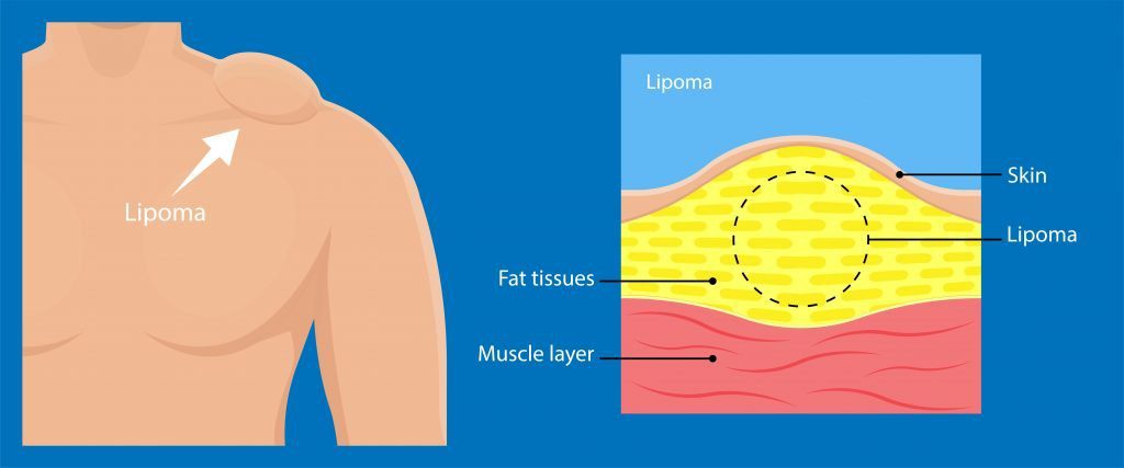Lipoma Removal by Dr. Gardner