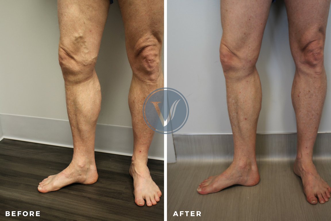 Relief After 18 Years of Suffering from Venous Disease