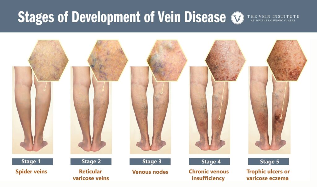 Stages of Vein Disease