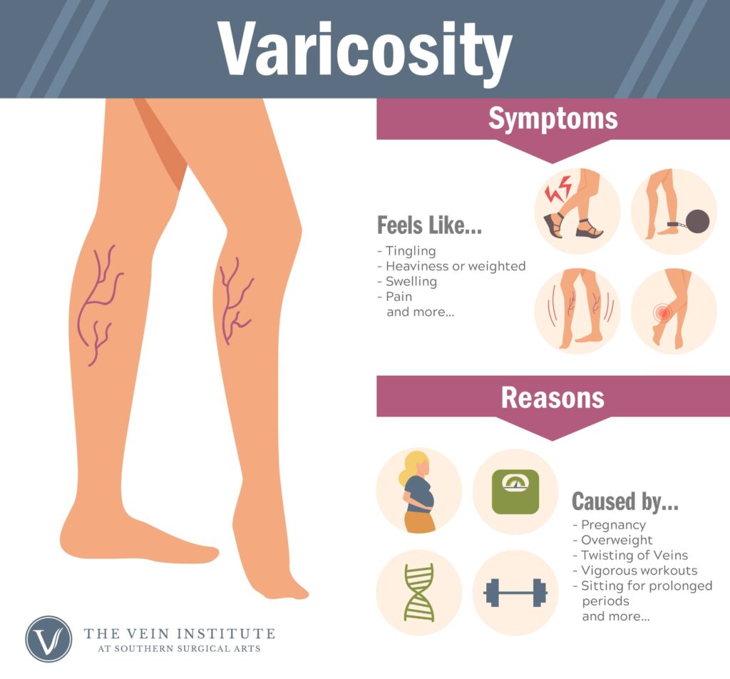 Symptoms and Causes of Varicosity
