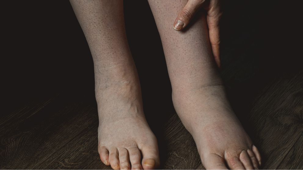 The Importance of Seeking Treatment for Lymphedema