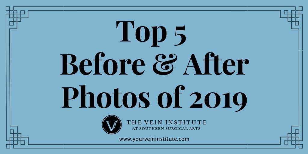 Top 5 Before and After Photos of Vein Treatment from 2019