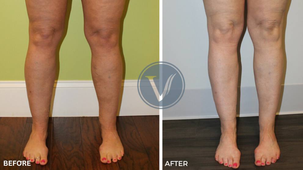 Treatment for Deep Vein Thrombosis and Varicose Veins