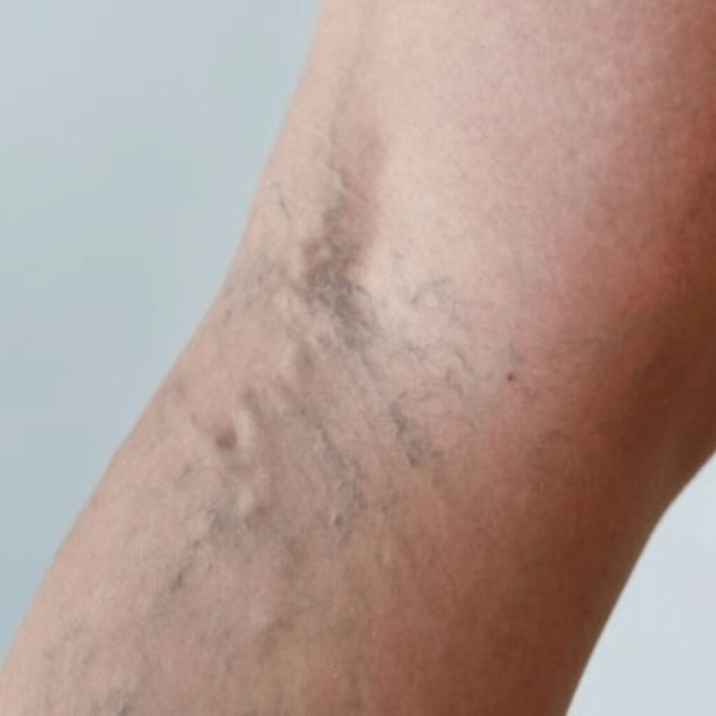 Unraveling the Veins: Understanding the Causes of Varicose Veins