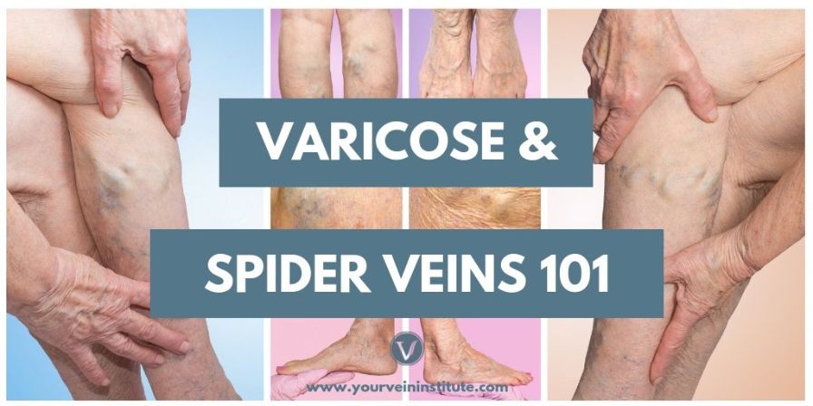 Varicose and Spider Veins 101