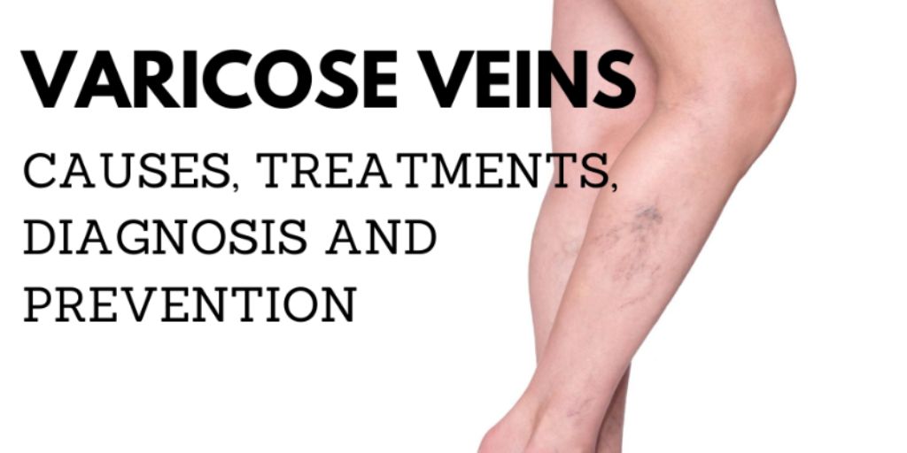 Varicose Veins: Causes, Treatment, Diagnosis, and Prevention