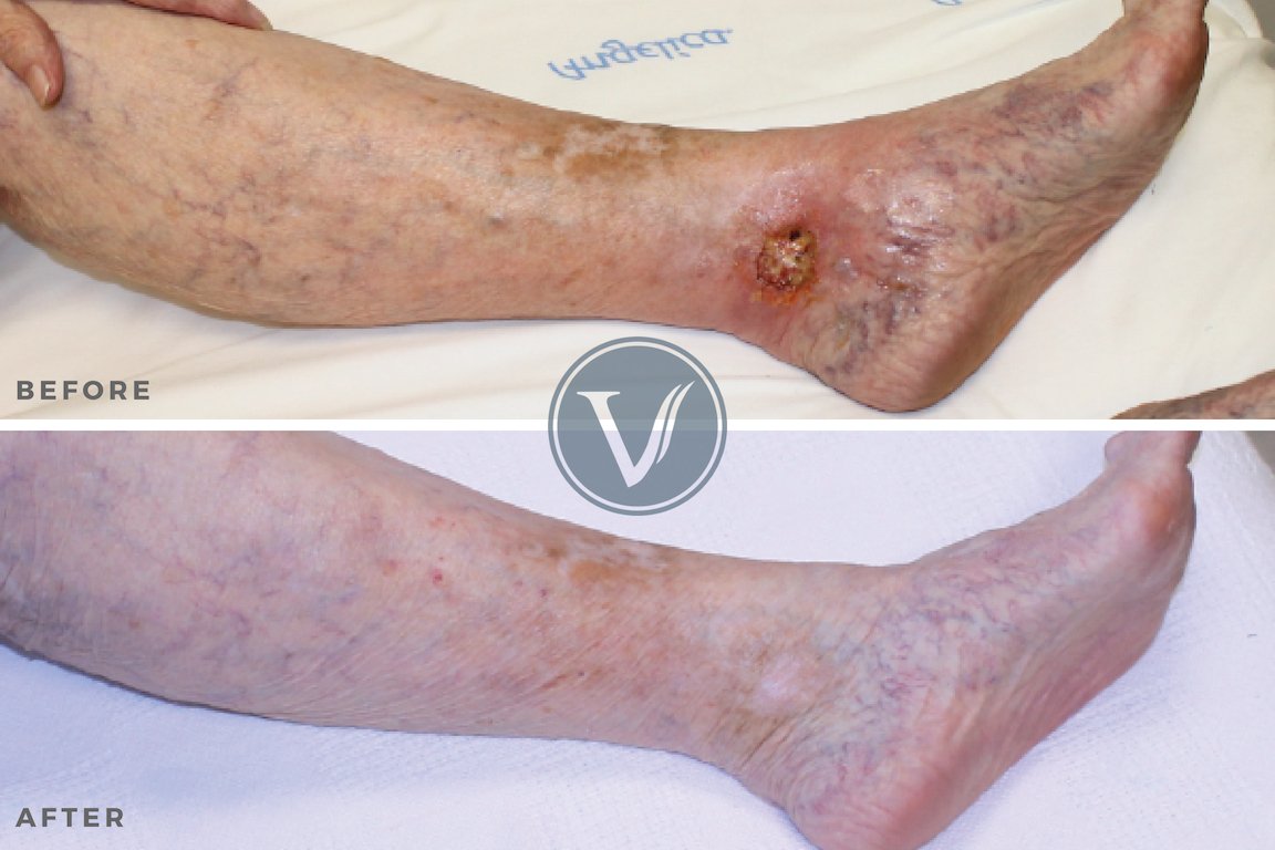 Venous Disease with Non-Healing Ulcer