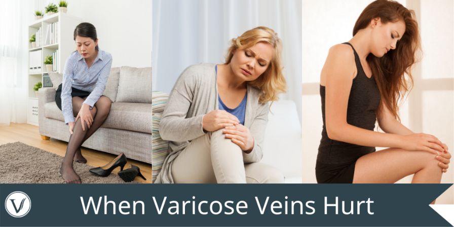 When Varicose Veins Hurt